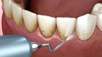 Diş Eti Hastalığı Nedir ? Dikkat Etmeniz Gereken Faktörler